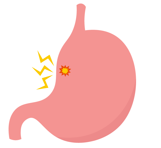 胃潰瘍