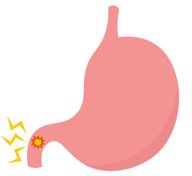 十二指腸潰瘍