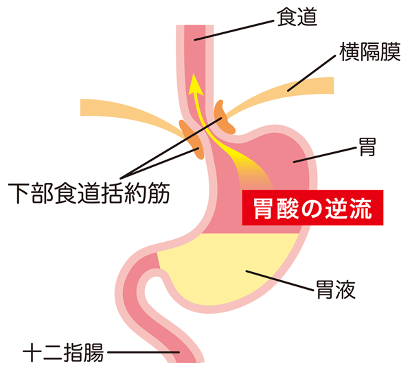 逆流性食道炎について医師が解説