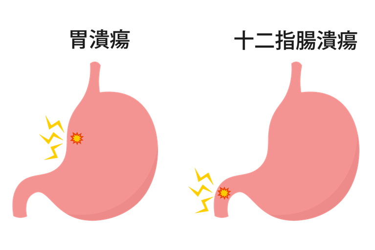 胃・十二指腸潰瘍